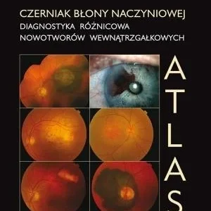 Wybór klientów CZERNIAK BŁONY NACZYNIOWEJ. DIAGNOSTYKA RŹNICOWA